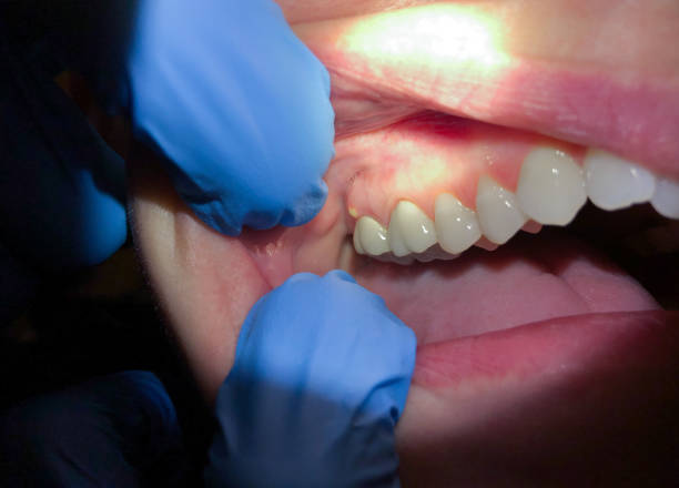 Best Emergency Gum Treatment in Granville South, OH