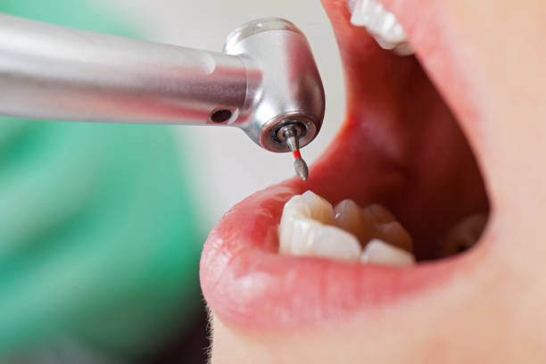 Best Emergency Root Canal Treatment in Granville South, OH